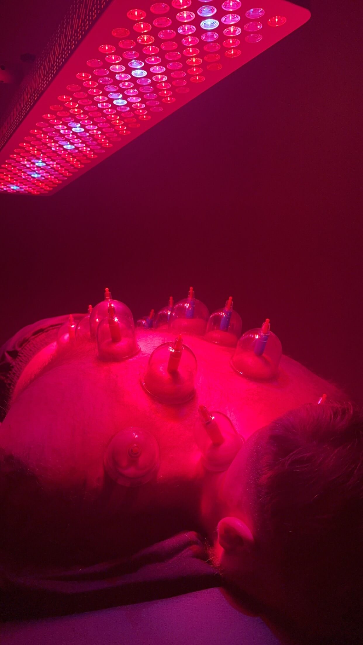 Cupping
